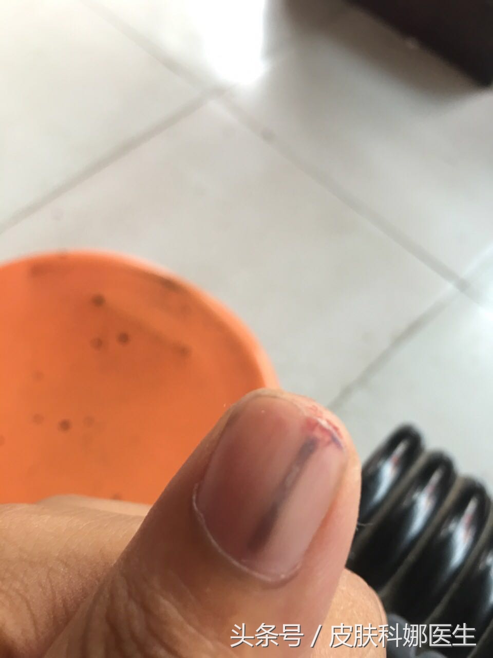 指甲里像扎了竹签一样痛什么原因,指甲壳里扎刺又肿又痛