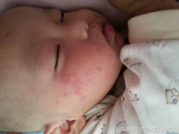 秋冬季节为什么特别干燥,天气湿热导致的湿疹怎么处理