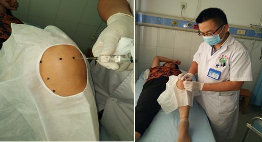 骨性关节炎针刀疗法视频,骨性关节炎损伤