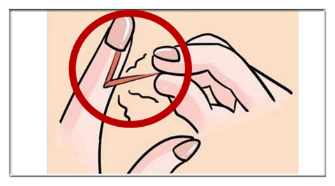 女子拔倒刺感染致整个指甲被拔掉,拔了根倒刺为什么会截肢