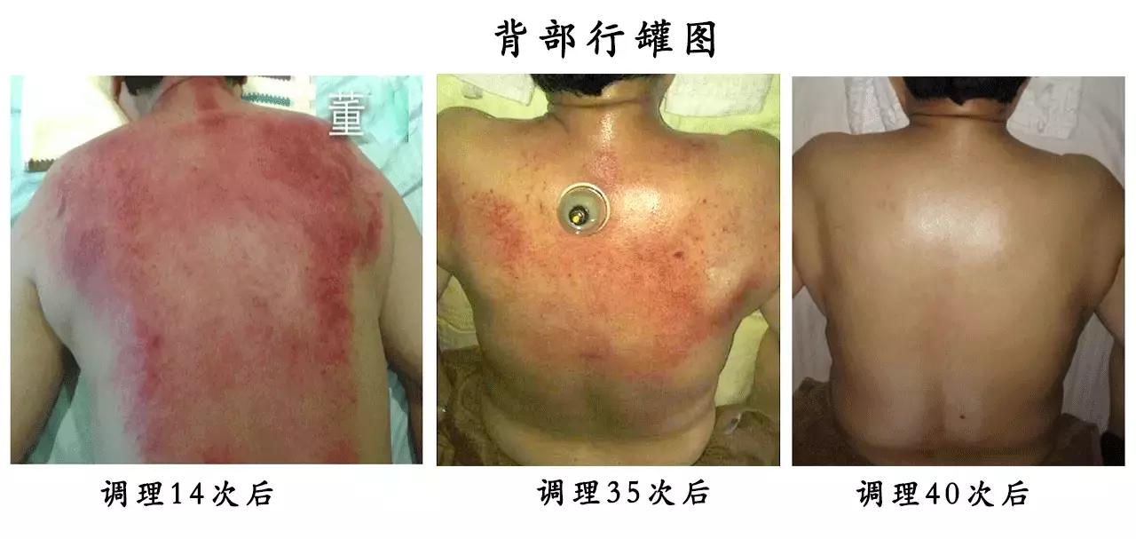 你还不懂美尼尔综合症是啥，她已经可以自愈了