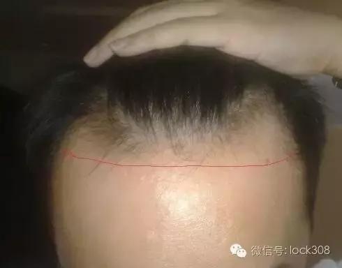 脂溢性脱发头顶脱发严重怎么办,头顶稀疏发缝宽脂溢性脱发怎么办