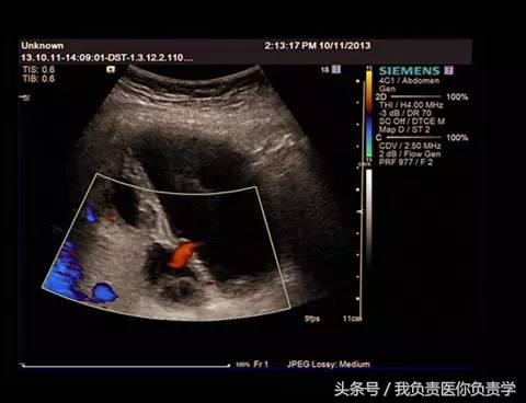 楂樻墜杩涢樁鑵拌吂璁粌,鑳嗗泭缁撶煶绌垮瓟鐥囩姸