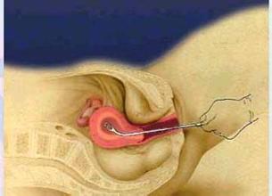 人工流产最好的方式,人工流产哪种方式最安全