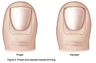 甲沟炎直接用一根牙签塞里面,甲沟炎牙线治疗视频