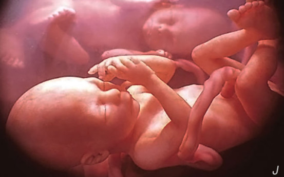 大部分怀孕的人是宫内孕还是宫外孕,双胞胎一个宫外孕一个宫内孕