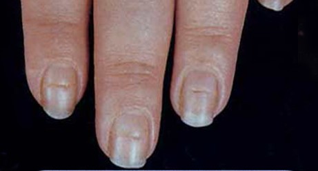 指甲的变化意味着身体的健康状况,指甲上出现这7症状是大病前兆