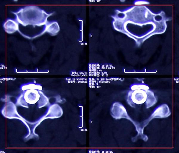 交感型颈椎病忌讳什么锻炼方法,交感型和椎动脉型颈椎病区别