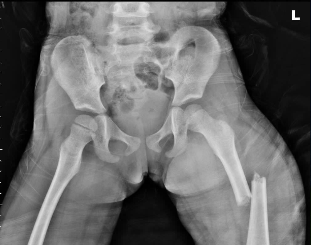 孩子不谨慎误食了酒精会死吗,小孩误食工业酒精怎么办