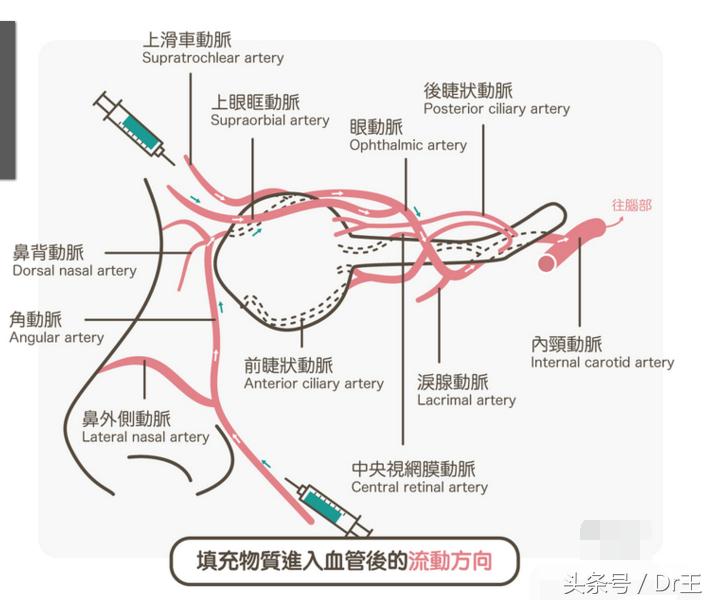 哈尔滨打玻尿酸右眼失明,玻尿酸打鼻子会导致失明吗