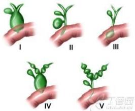 术后慢性腹痛怎么治疗,前交叉术后持续发烧疼痛