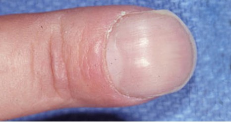 指甲的变化意味着身体的健康状况,指甲上出现这7症状是大病前兆