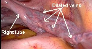 左下腹痛会是静脉曲张吗,动脉曲张与肚子疼