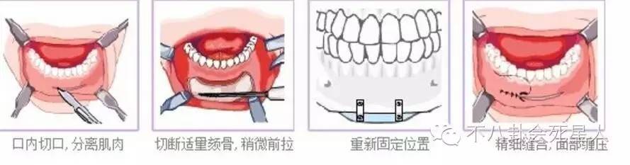 沈梦辰整下巴,沈梦辰有没有整下颚角