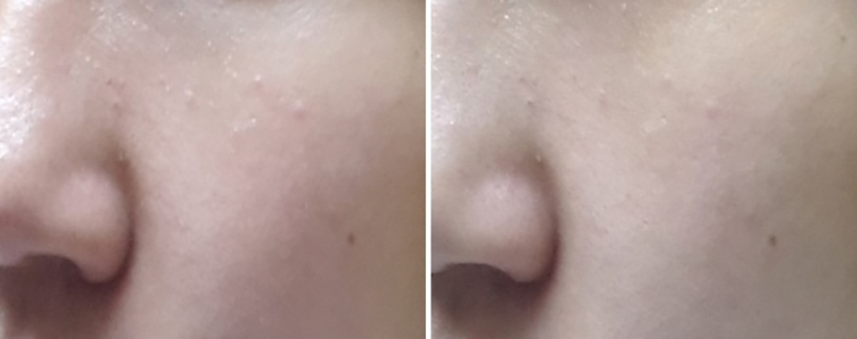 脖子闭口粉刺怎么去除小妙招,粉刺怎么去除简单方法学生