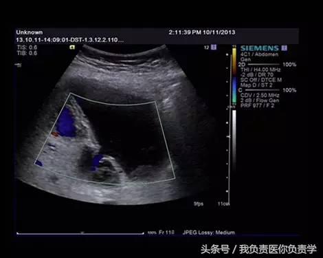 楂樻墜杩涢樁鑵拌吂璁粌,鑳嗗泭缁撶煶绌垮瓟鐥囩姸