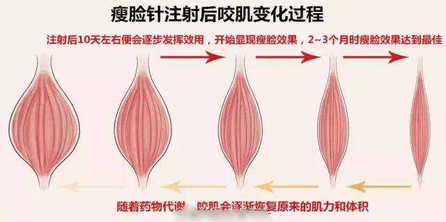 瘦脸针打完多久效果最明显自然,打瘦脸针笑容僵硬怎么能恢复快点