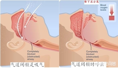 睡觉打呼噜最好的治疗方法,为什么只有睡觉时才打呼噜