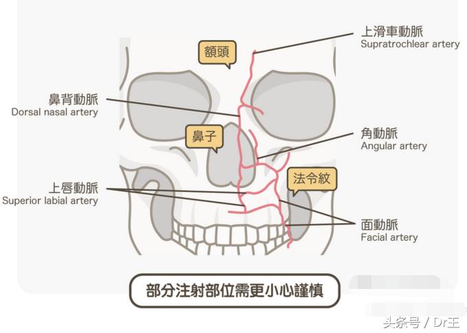 哈尔滨打玻尿酸右眼失明,玻尿酸打鼻子会导致失明吗