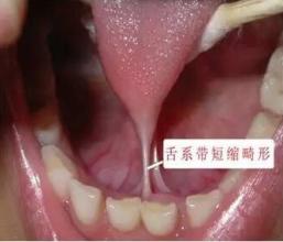 舌头下面系带处溃疡怎么治,舌头下面的系带有什么用