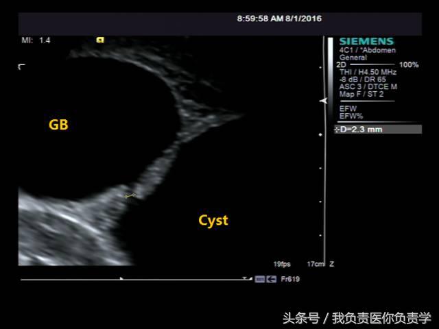 楂樻墜杩涢樁鑵拌吂璁粌,鑳嗗泭缁撶煶绌垮瓟鐥囩姸