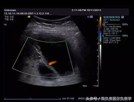 楂樻墜杩涢樁鑵拌吂璁粌,鑳嗗泭缁撶煶绌垮瓟鐥囩姸