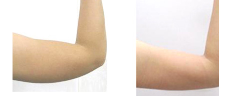 怎么快速瘦胳膊最快方法,甩胳膊能瘦胳膊吗