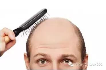 脂溢性脱发头顶脱发严重怎么办,头顶稀疏发缝宽脂溢性脱发怎么办