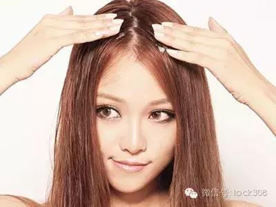 脂溢性脱发头顶脱发严重怎么办,头顶稀疏发缝宽脂溢性脱发怎么办