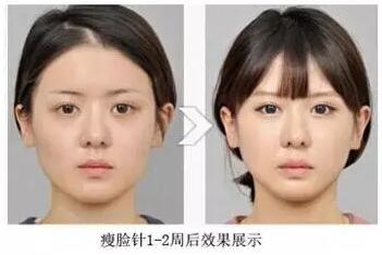 瘦脸针打完多久效果最明显自然,打瘦脸针笑容僵硬怎么能恢复快点