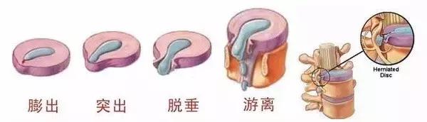 解决腰痛的腰椎锻炼方法,练一下腰椎的操