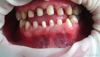 装了烤瓷牙真的是一条不归路吗,烤瓷牙做了后悔一辈子