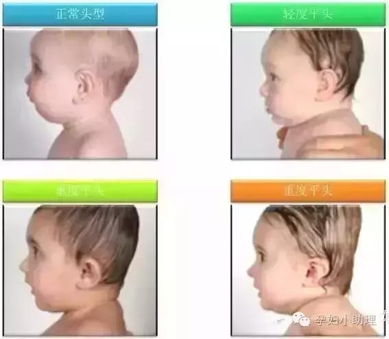 宝宝睡平头是天大的误区,宝宝能睡平头吗