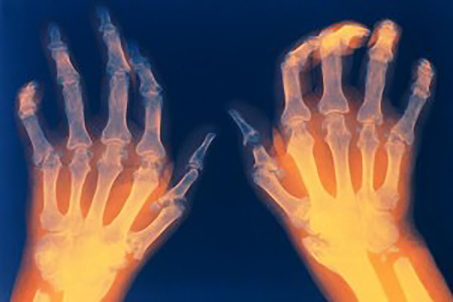 风湿寒性膝关节炎积液如何消除,风湿性关节炎的中医治疗视频