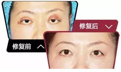 埋线双眼皮术后失败修复简单吗,埋线双眼皮眼睑外翻怎么修复