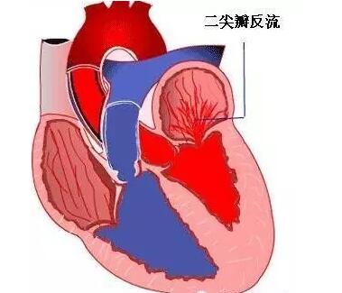 先心病手术后二尖瓣重度返流,先心病术后三尖瓣轻度返流要紧吗