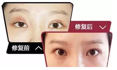 埋线双眼皮术后失败修复简单吗,埋线双眼皮眼睑外翻怎么修复
