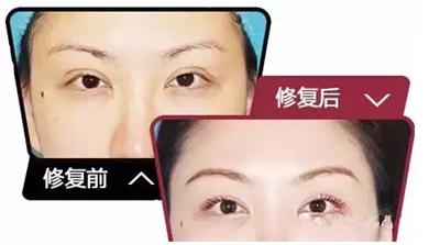 埋线双眼皮术后失败修复简单吗,埋线双眼皮眼睑外翻怎么修复