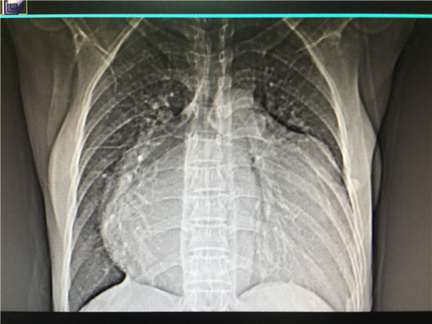 一女子突发心脏病,女子因感冒引起心脏停跳72小时