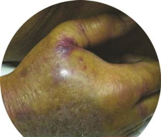 蟹钳坏了会中毒吗,蟹钳夹到手流血肿了会死吗