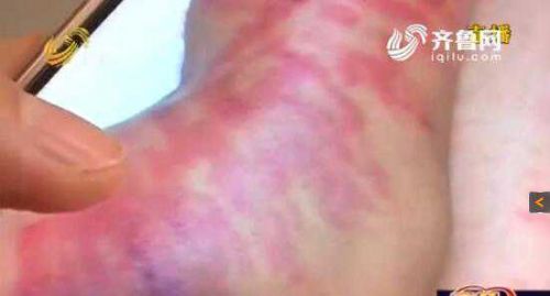 青岛女子做激光脱毛变“斑马腿”大片红肿还起泡
