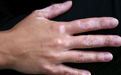 小孩手脱皮是什么原因怎么治,12岁男孩手脱皮是什么原因