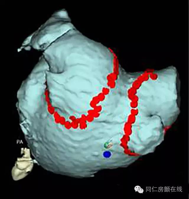 射频消融手术治房颤,房颤的射频消融术指南解读