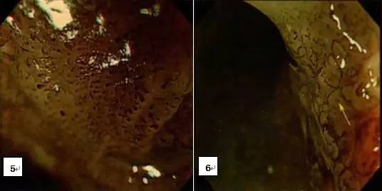 早期贲门癌内镜特征,内镜早癌