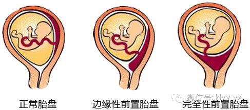 分娩见红为什么还没开宫口,临产前见红一定是分娩前兆吗
