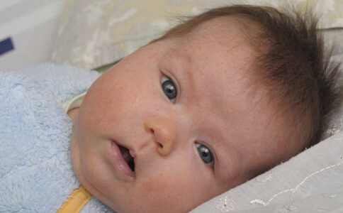 湿疹反复发作应关注四点,面部湿疹饮食要关注什么