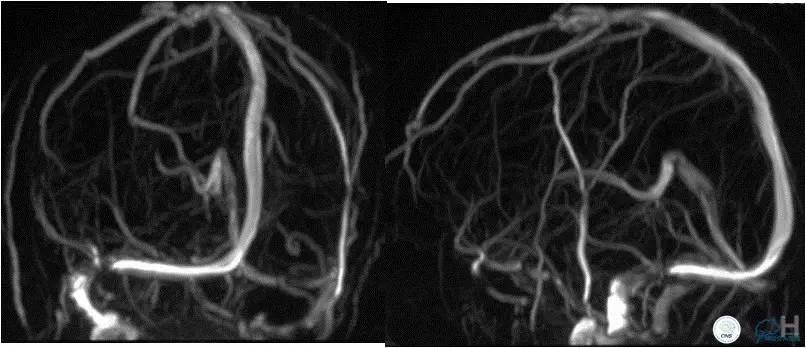 脑静脉窦狭窄放支架还能工作吗,颅内动脉支架植入术治疗血管狭窄