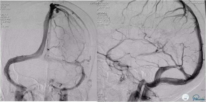脑静脉窦狭窄放支架还能工作吗,颅内动脉支架植入术治疗血管狭窄