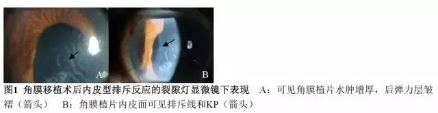 角膜内皮移植排斥反应大吗,角膜内皮移植术后的影响