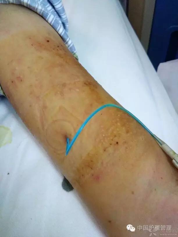 picc管旁边皮肤痒怎么办,picc膜内皮肤痒